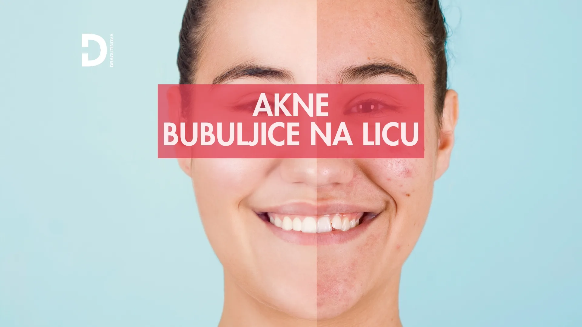 akne i bubuljice na licu i telu lečenje terapija za akne - Dragutinova akne i bubuljice na licu i telu lečenje terapija za akne