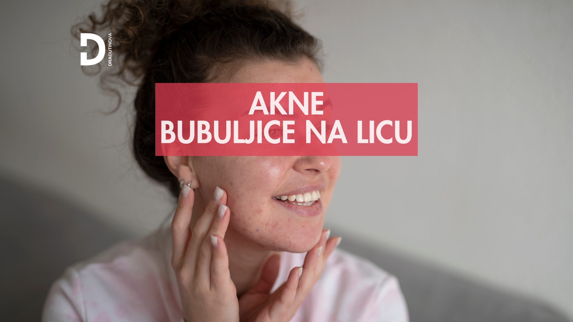 akne i bubuljice na licu ceđenje krema losion lečenje potkožne bubuljice