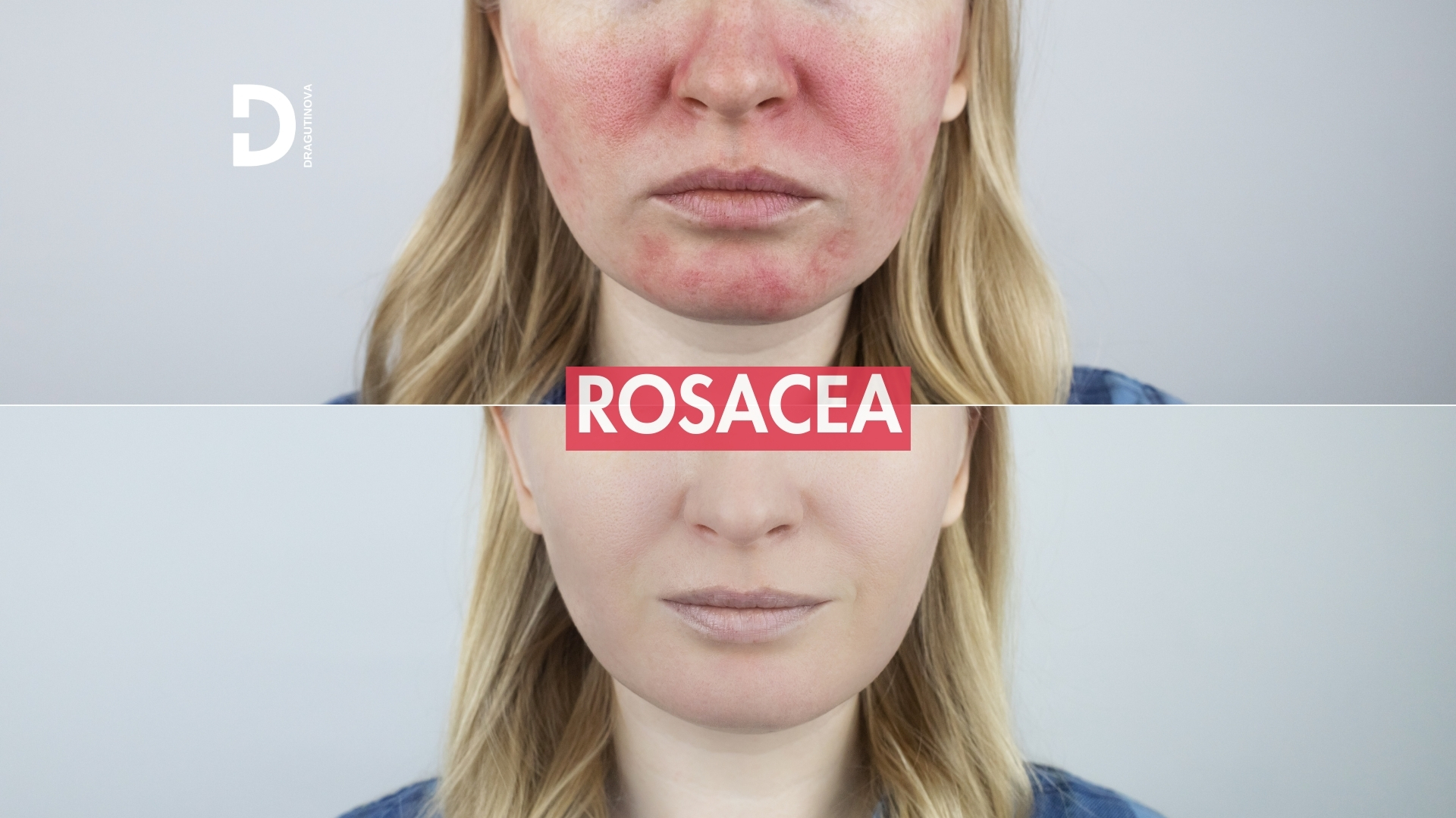 rosacea rozacea acne rosacea kuperoza