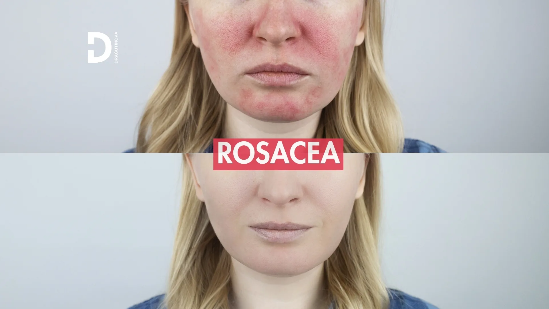 rosacea rozacea acne rosacea kuperoza - Dragutinova rosacea rozacea acne rosacea kuperoza