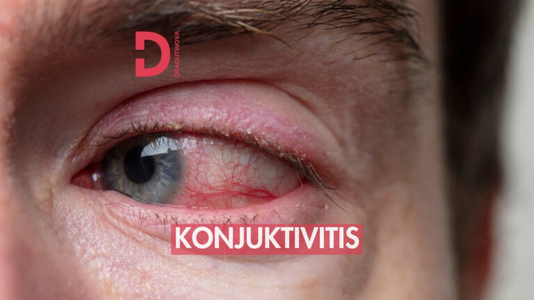 konjuktivitis, konjuktivis kod dece, konjuktivitis kod beba