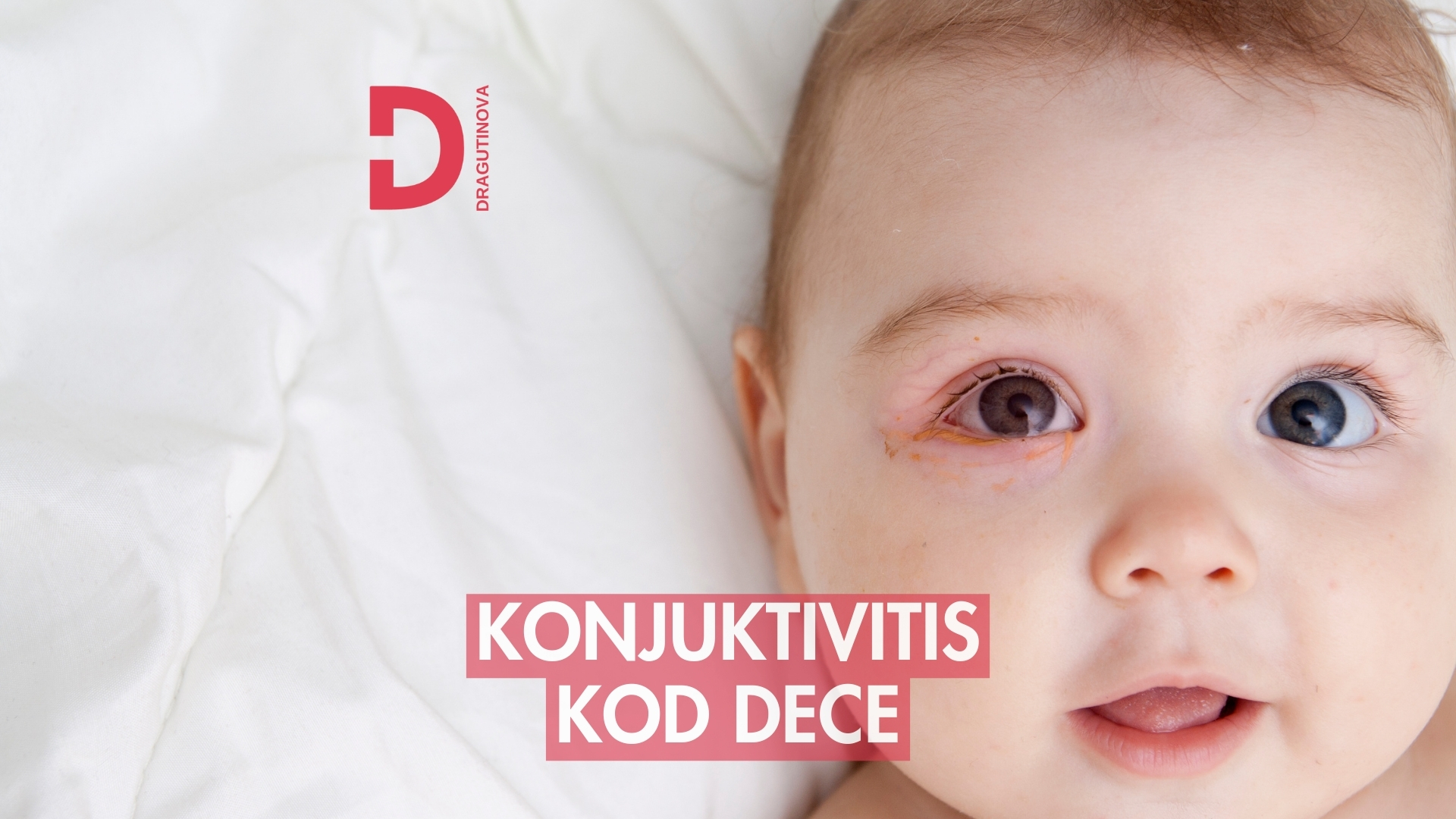 konjuktivitis, konjuktivis kod dece, konjuktivitis kod beba