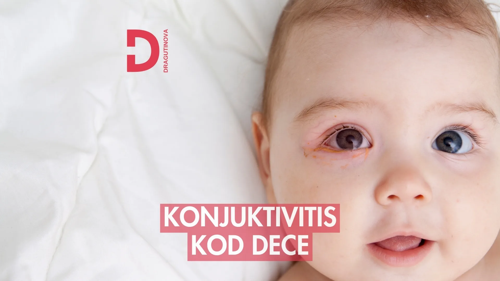 konjuktivitis, konjuktivis kod dece, konjuktivitis kod beba - Dragutinova konjuktivitis, konjuktivis kod dece, konjuktivitis kod beba